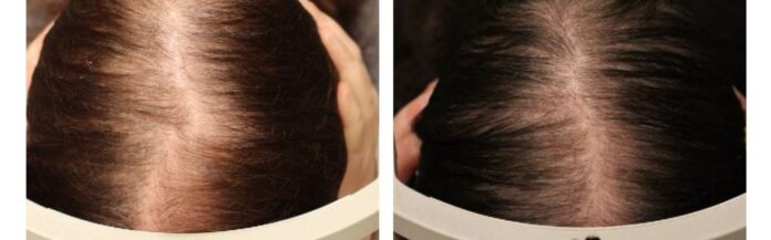 Médico entrega recomendaciones para combatir la alopecia androgénica y derriba mitos en torno a ella