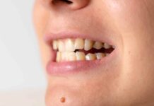 Ortodoncia lingual, la solución definitiva para problemas dentales complejos 