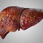 Investigadores de Mayo Clinic asocian mutación hereditaria con enfermedad del hígado graso