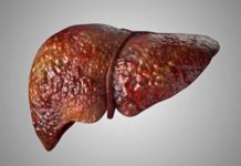 Investigadores de Mayo Clinic asocian mutación hereditaria con enfermedad del hígado graso