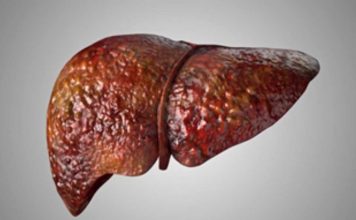 Investigadores de Mayo Clinic asocian mutación hereditaria con enfermedad del hígado graso