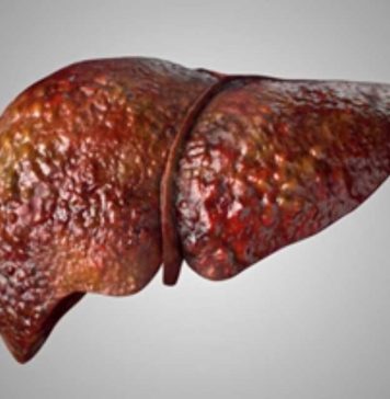 Investigadores de Mayo Clinic asocian mutación hereditaria con enfermedad del hígado graso