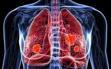 Novedades en el tratamiento del cáncer de pulmón: nuevas indicaciones alcanzaron reducciones significativas en progresión o muerte en comparación con la terapia convencional