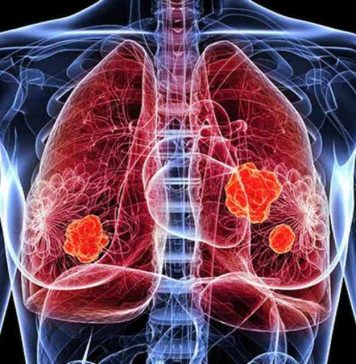 Novedades en el tratamiento del cáncer de pulmón: nuevas indicaciones alcanzaron reducciones significativas en progresión o muerte en comparación con la terapia convencional Novedades en el tratamiento del cáncer de pulmón: nuevas indicaciones alcanzaron reducciones significativas en progresión o muerte en comparación con la terapia convencional